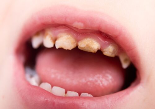 Tooth decay affects 22% of five-year-olds as progress stalls