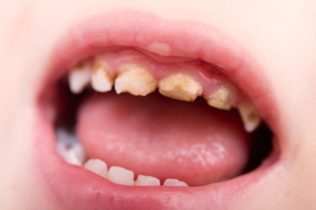 Tooth decay affects 22% of five-year-olds as progress stalls